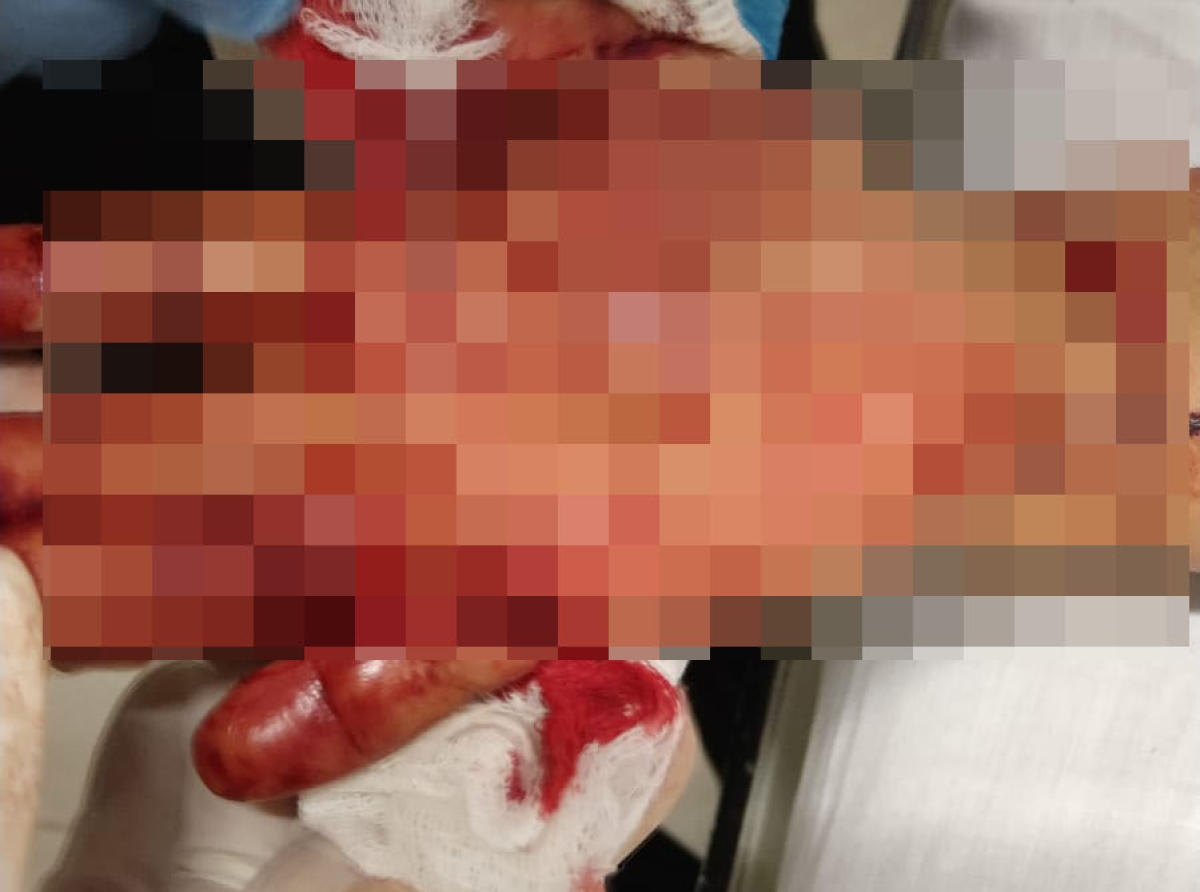 Mujer es atacada con un machete por su ex pareja en la comunidad de San Juan Tlale